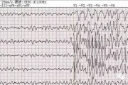 请牢记这些致命的心电图，临床医生必备！