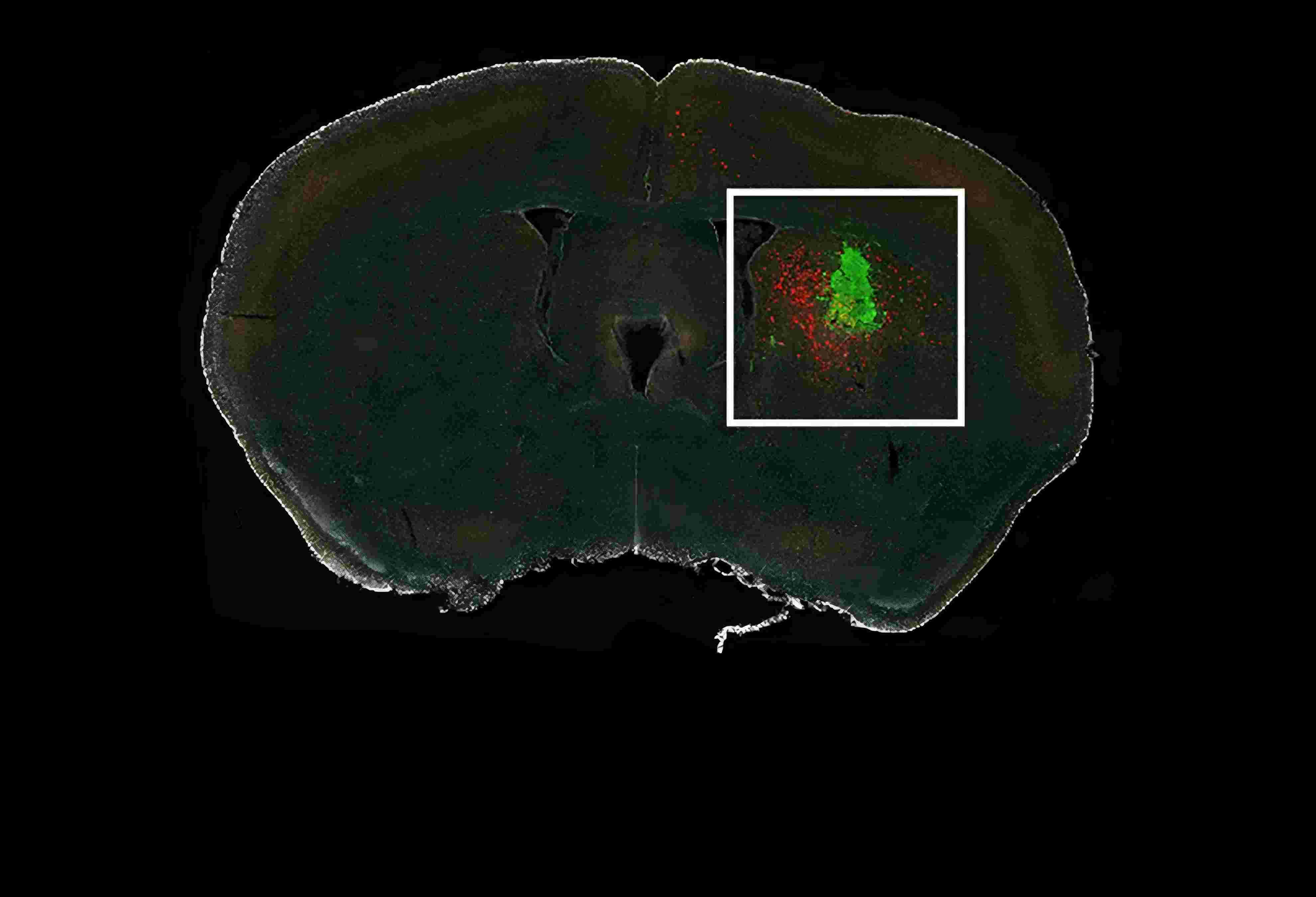 1350glioma-850(2).jpg